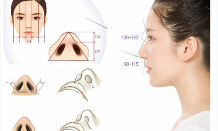 Nâng mũi cấu trúc – phương pháp cải thiện toàn diện dáng mũi