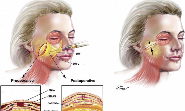 Những điều bạn nên biết về phẫu thuật căng da mặt