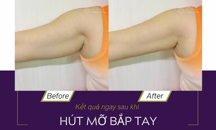 Arm Liposuction: The Secret to Sleeker Arms, Removing 5-8cm of Stubborn Fat
