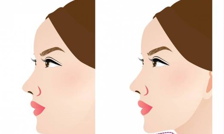 Chin Liposuction: The Complete Guide to Sculpting Your Jawline and Enhancing Your Appearance
