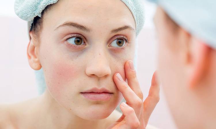 Meso teoxane - Tinh chất trị thâm quầng mắt hiệu quả