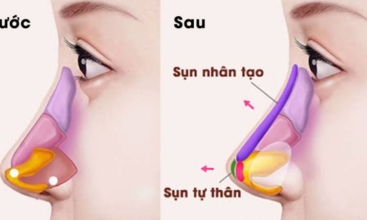 Nâng mũi tự nhiên - Mũi đẹp chuẩn dáng sao Hàn