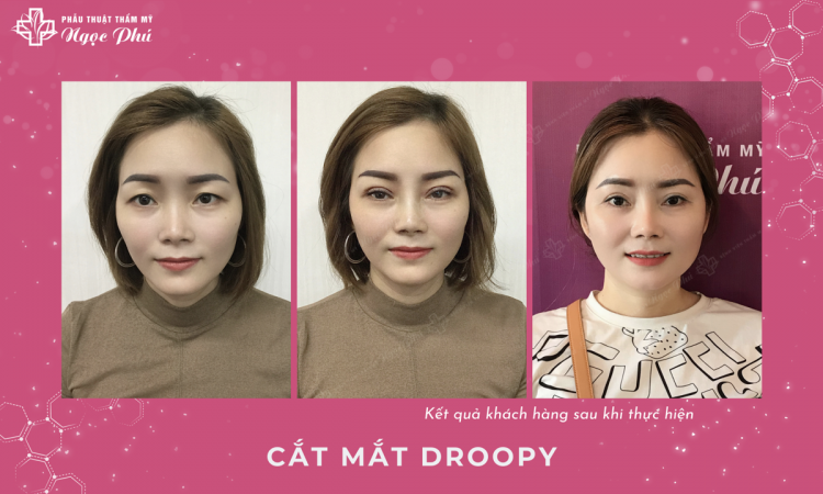 Cắt Mắt Droopy