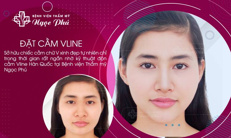 Vline Chin Augmentation Surgery