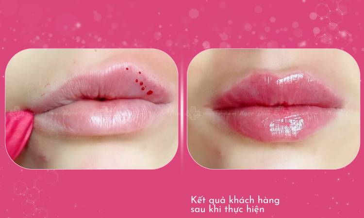 Lip Filler (Non-surgical Lip Augmentation)