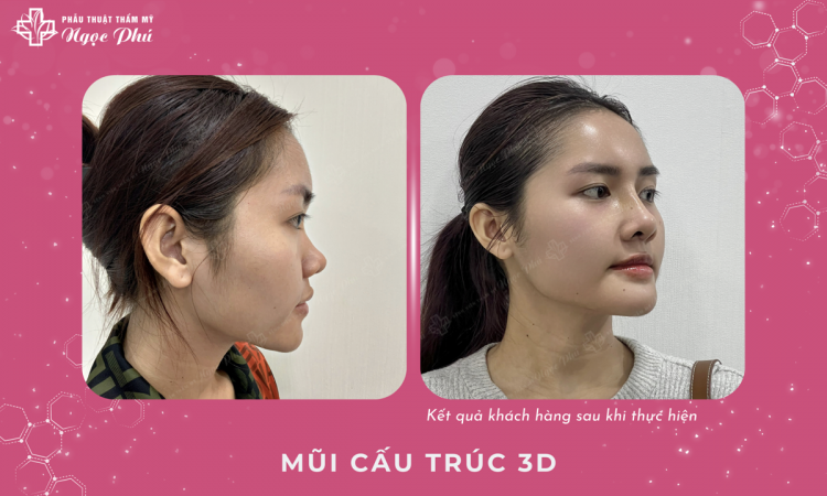 3D Structural Rhinoplasty