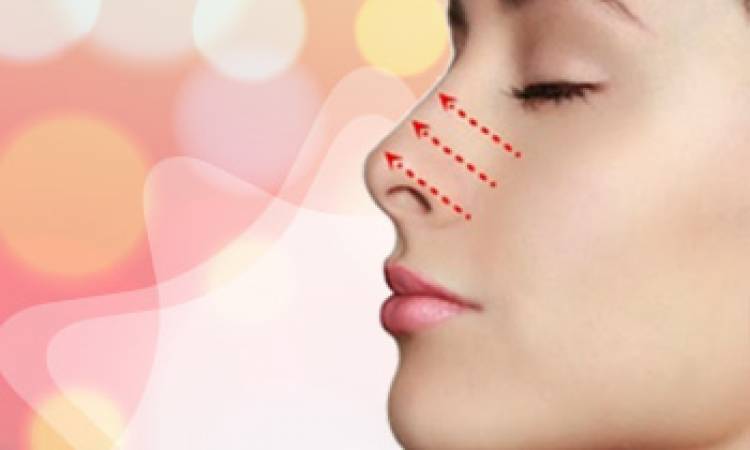 Nâng mũi Sline – công nghệ nâng mũi đẹp toàn diện