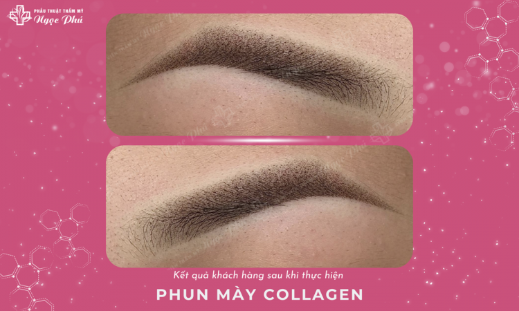 Phun Mày Collagen