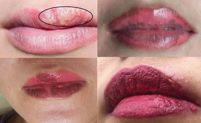 Dấu hiệu phun môi bị nhiễm trùng và cách xử lý  Bệnh Viện Thẩm Mỹ Ngọc Phú