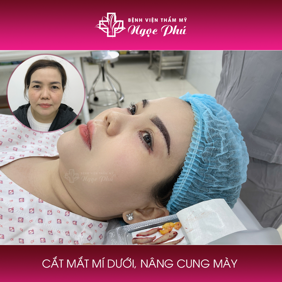 Nâng cung mày - Bệnh viện Thẩm mỹ Ngọc Phú