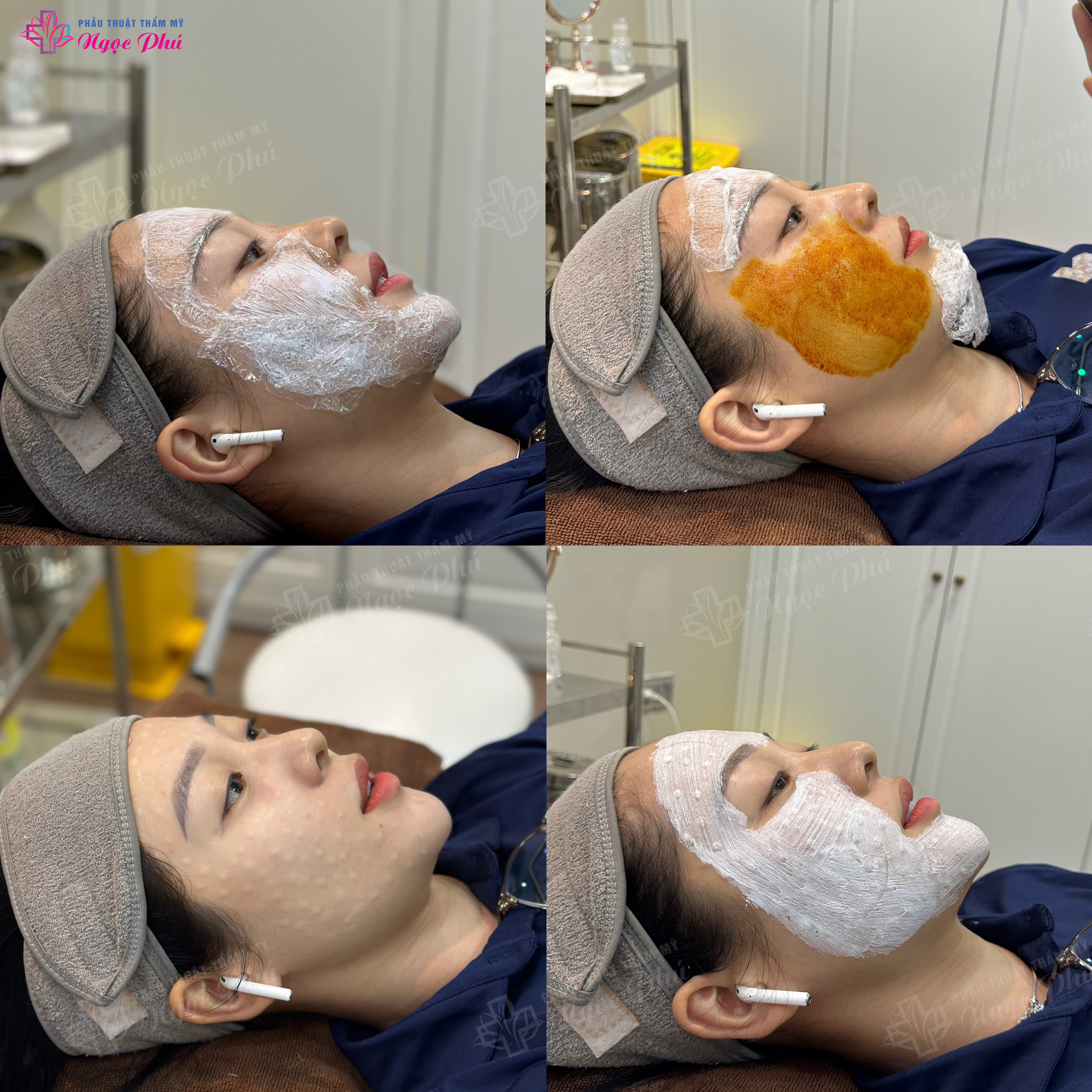 Công nghệ Tiêm Mesotherapy tại Thẩm mỹ Ngọc Phú là một trong những công nghệ làm đẹp xâm lấn tối thiểu giúp làn da khỏe khoắn, săn chắc và mịn màng.