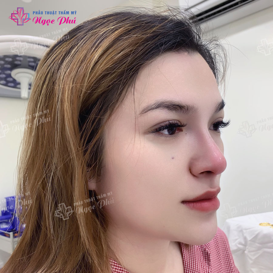 Ngày nay, phương pháp nâng mũi s line ngày càng được nhiều khách hàng nữ quan tâm về kỹ thuật nâng mũi này. 