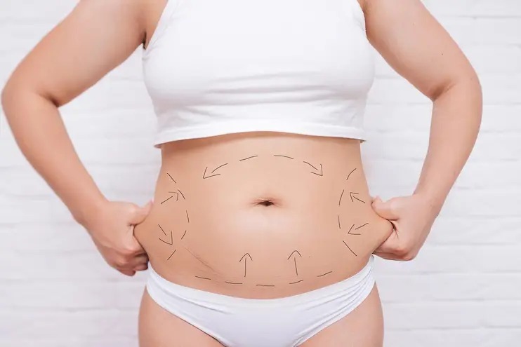 Hút mỡ bụng là một phương pháp thẩm mỹ được nhiều người lựa chọn để loại bỏ mỡ thừa, giúp cơ thể thon gọn và săn chắc hơn.