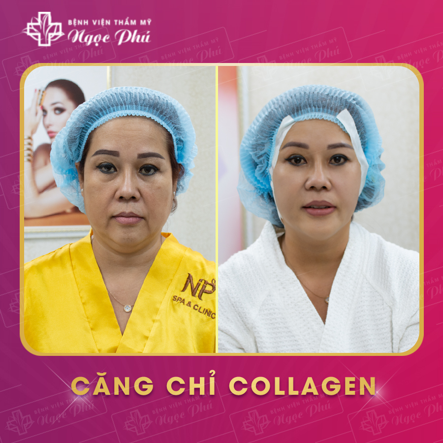 Khi chưa có phương pháp căng chỉ collagen, phẫu thuật căng da được biết đến như một lựa chọn phổ biến.