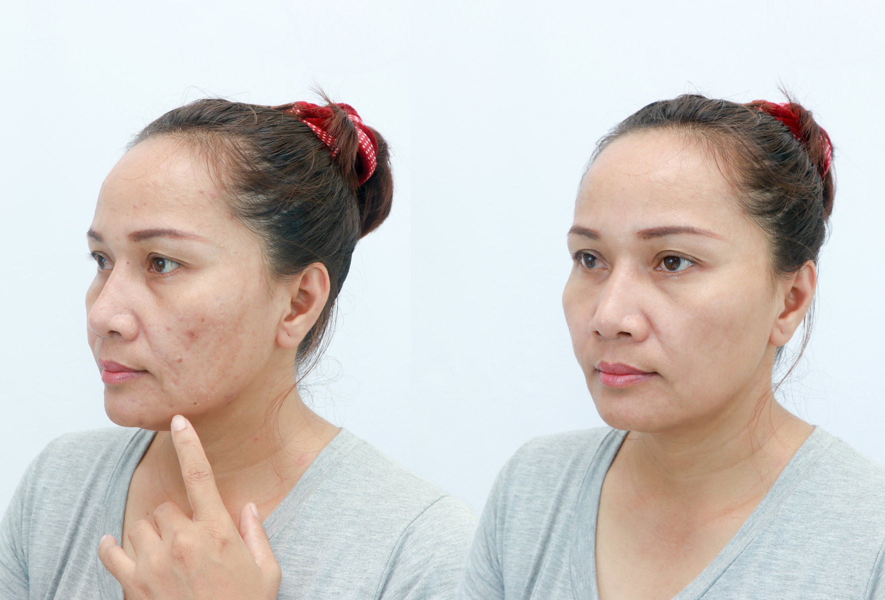 Phương pháp căng chỉ vàng cho da mặt đang được coi là một trong những dịch vụ an toàn và hiệu quả nhất hiện nay.