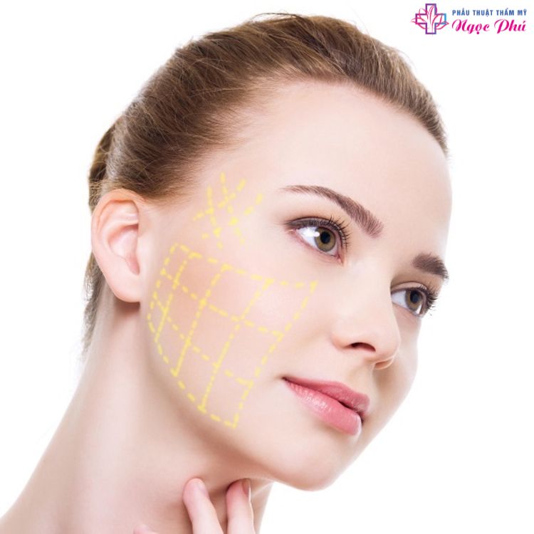 Phương pháp trẻ hóa da bằng cách căng chỉ vàng là một trong những xu hướng làm đẹp phổ biến đối với chị em, phương pháp này sử dụng kết hợp các loại chỉ PDO hoặc PPL được phủ bên ngoài là một lớp vàng nano.