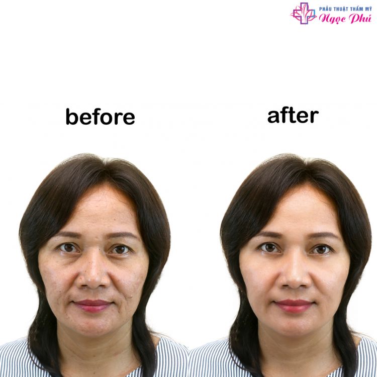 Phương pháp làm đẹp cực kỳ phổ biến hiện nay là cải thiện độ đàn hồi da bằng cách căng chỉ vàng, phương pháp sử dụng chỉ vàng đưa vào cơ thể để nâng cơ mặt.