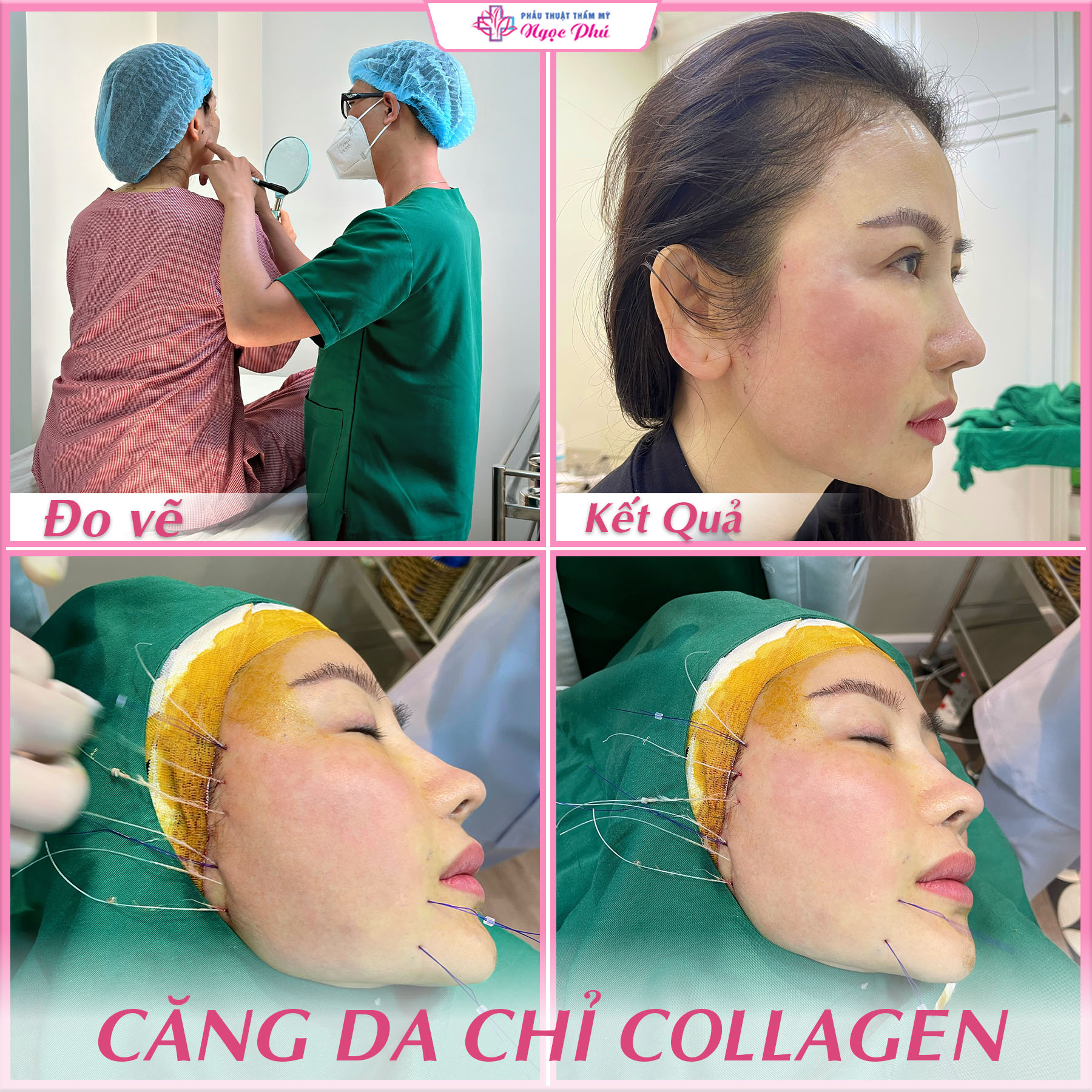 Quy trình căng da mặt bằng chỉ collagen tại Thẩm mỹ Ngọc Phú