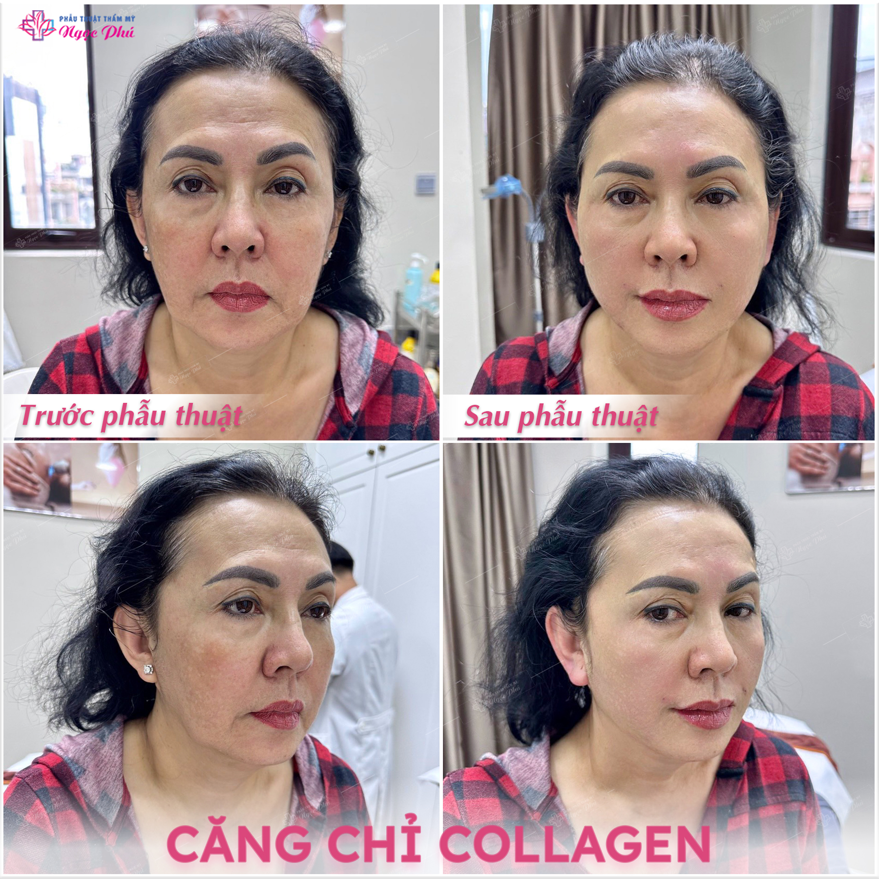 Khách hàng trước và sau khi căng da mặt bằng chỉ collagen tại Thẩm mỹ Ngọc Phú