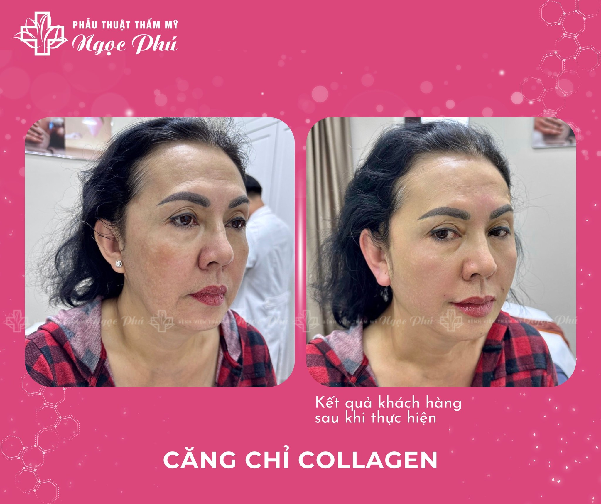 Căng da mặt bằng chỉ collagen có tốt không là câu hỏi được nhiều khách hàng đặt ra.