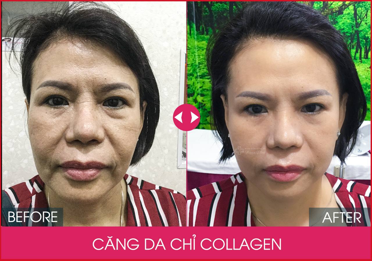 Căng da mặt bằng chỉ Collagen là một thủ thuật không xâm lấn sử dụng chỉ Collagen để nâng đỡ và săn chắc da. 