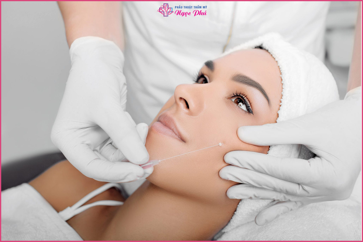 Căng da mặt bằng chỉ collagen hiện là phương pháp trẻ hóa được nhiều chị em lựa chọn.