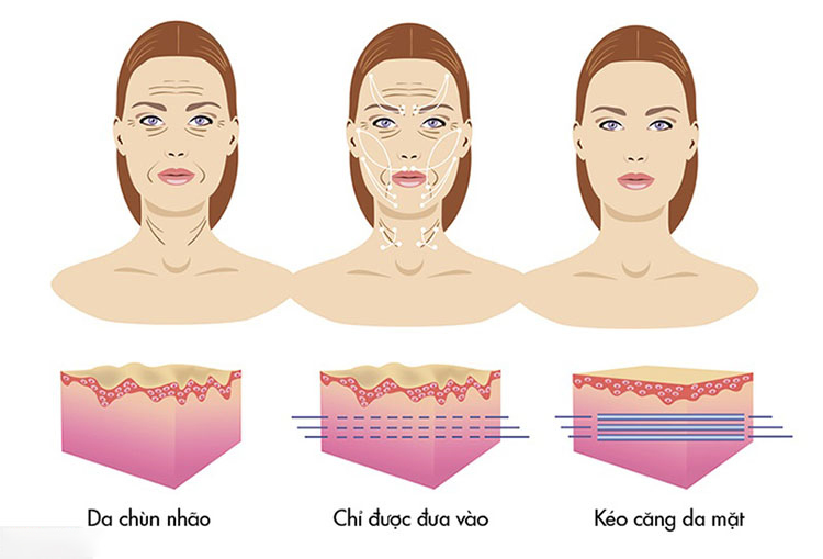 Cấy chỉ collagen trong căng da mặt, thường áp dụng đối với những khách hàng có nhu cầu cải thiện vùng da bị lão hóa từ nhẹ đến trung bình.