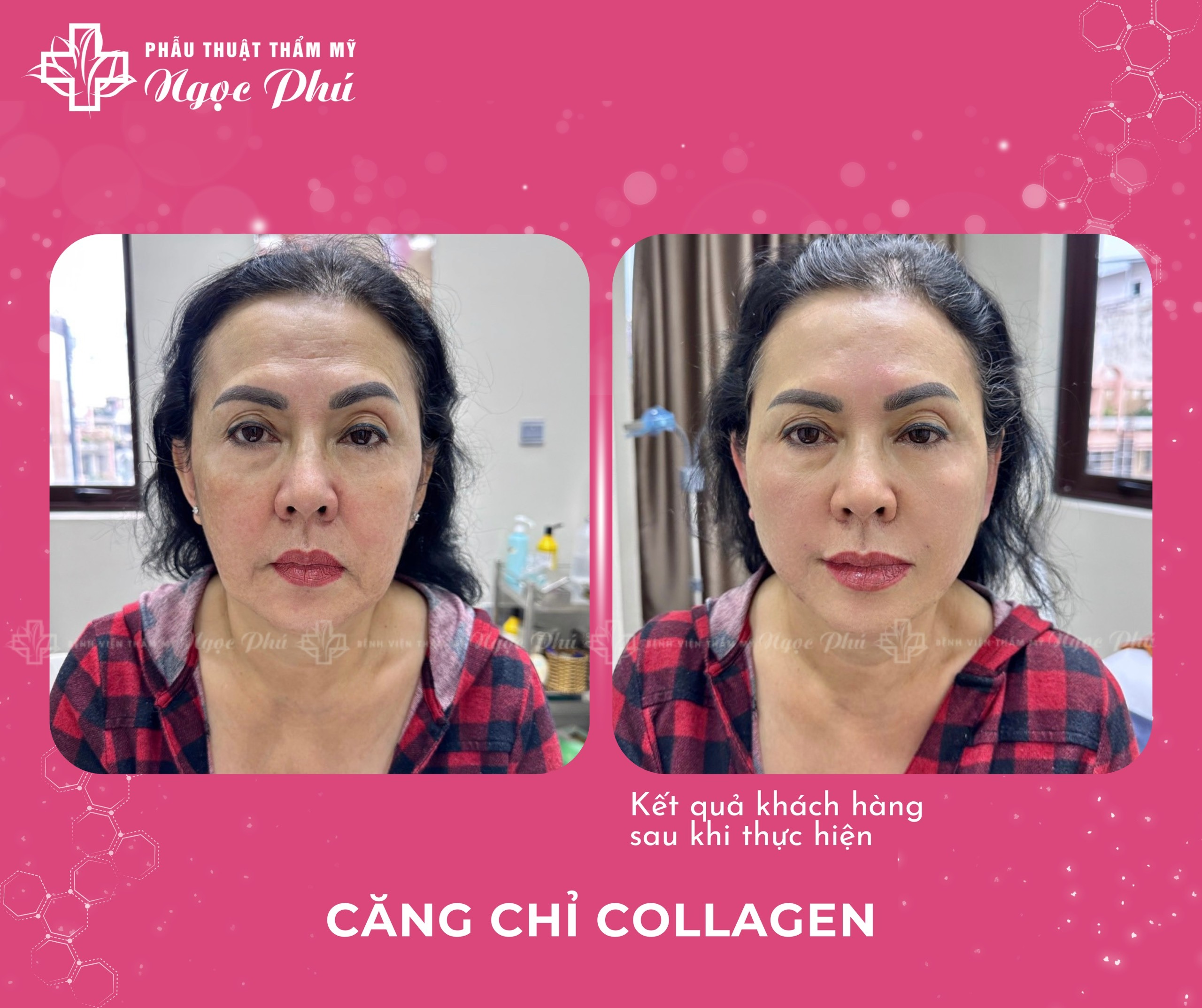 Căng da mặt không phẫu thuật - Căng chỉ Collagen