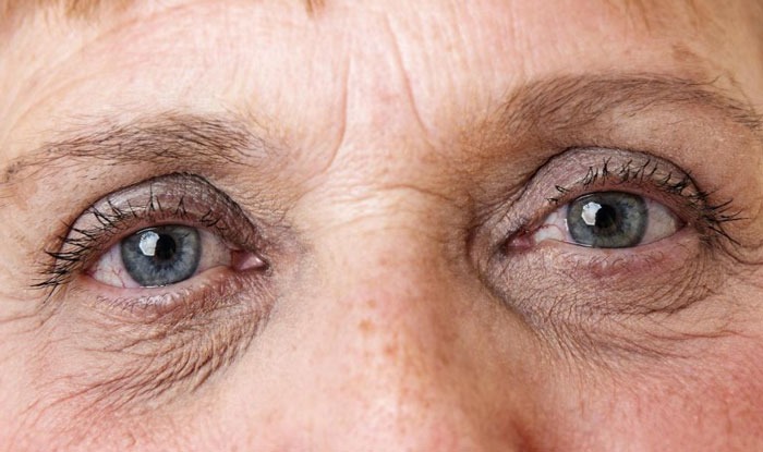Căng da mí không phẫu thuật là phương pháp thẩm mỹ tiên tiến giúp trẻ hóa đôi mắt hiệu quả mà không cần dao kéo.