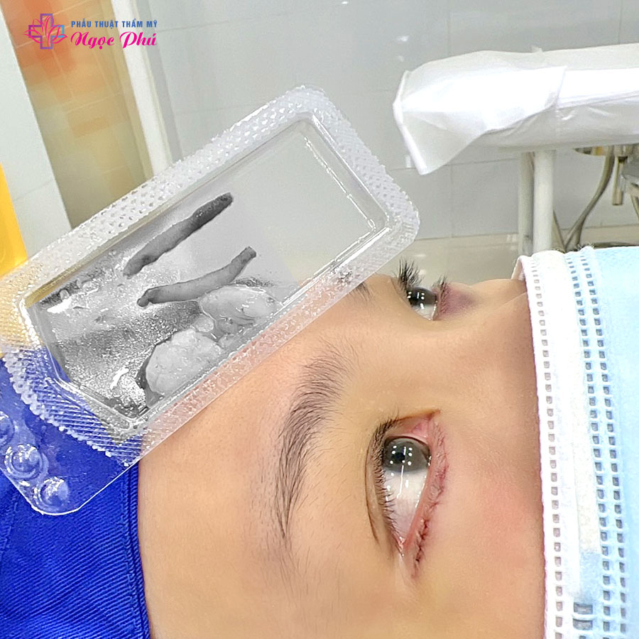 Cắt bọng mắt mí dưới là một thủ thuật an toàn và hiệu quả, có thể giúp bạn sở hữu đôi mắt trẻ trung và rạng rỡ hơn.