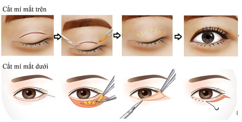 Người có da thừa, bọng mắt ở vùng mắt dưới: Da thừa và bọng mắt là những dấu hiệu lão hóa phổ biến ở vùng mắt.