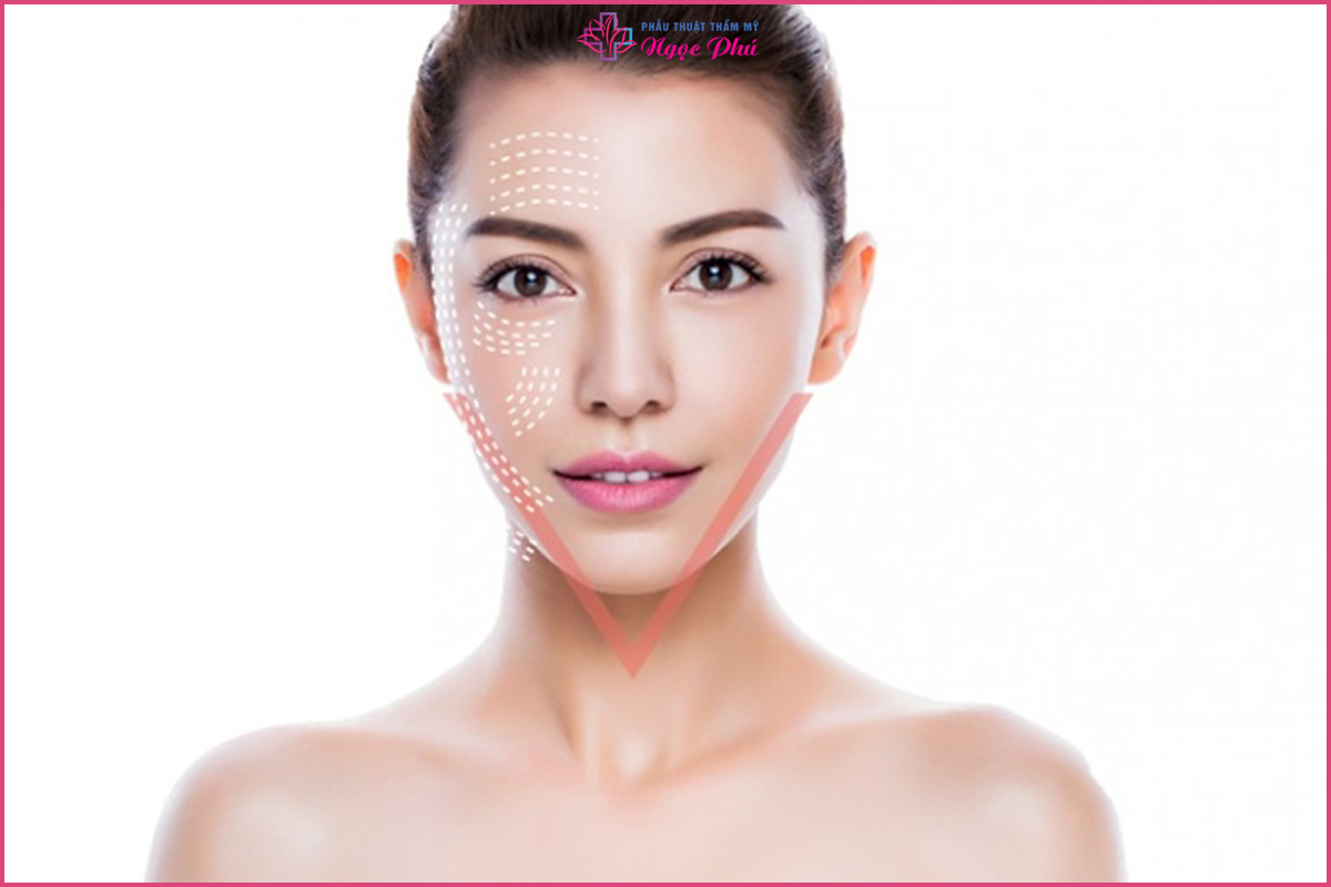 Cấy chỉ căng da mặt là thụt thuật nằm giúp khuôn mặt được trẻ hóa mà không cần phẫu thuật.