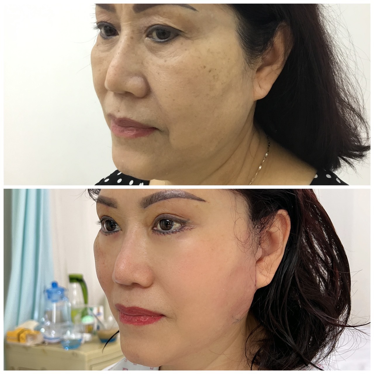 Chăm sóc sau phẫu thuật căng da mặt như thế nào để có kết quả đẹp và an toàn