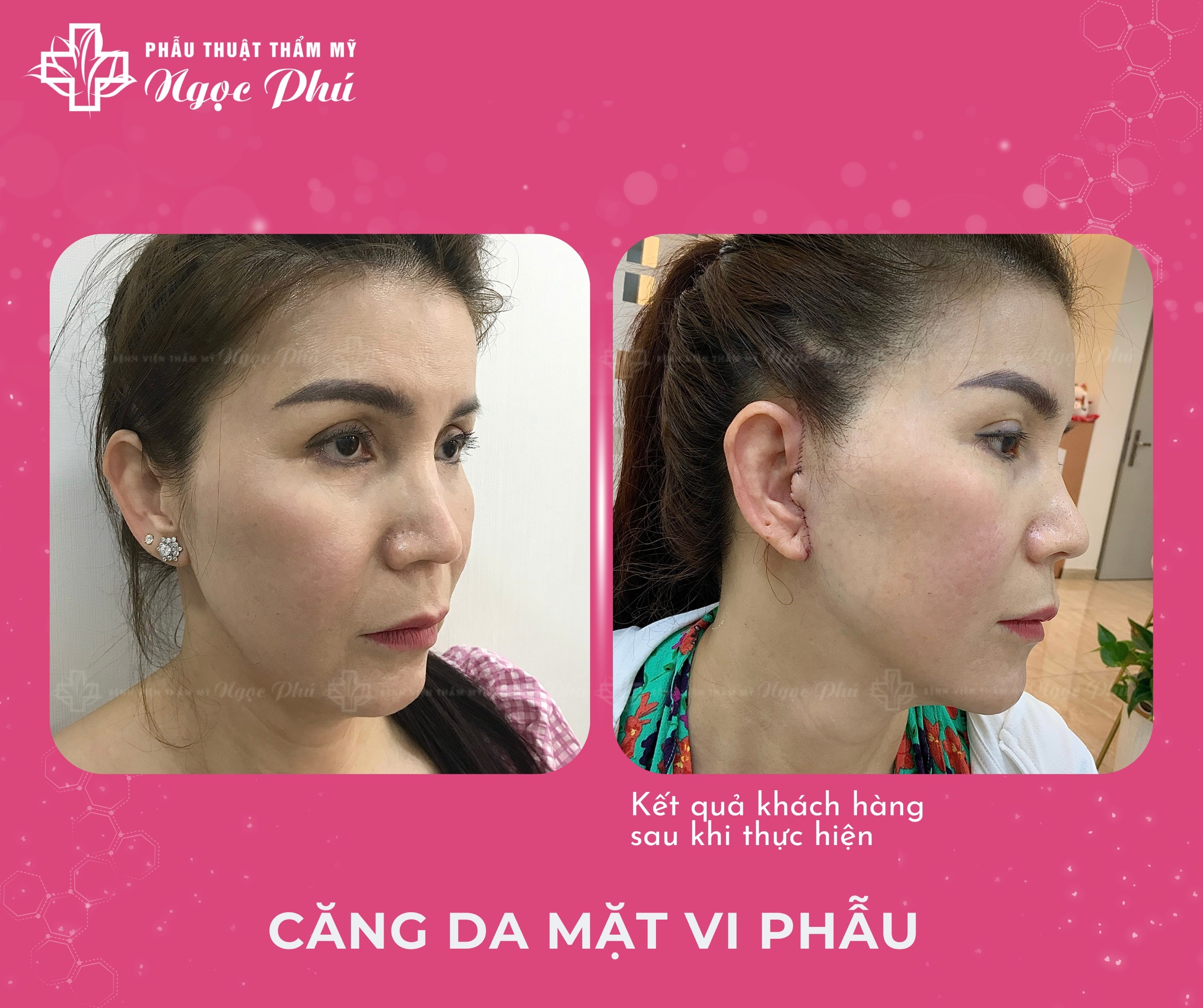 Kết quả của khách hàng về chăm sóc sau phẫu thuật căng da mặt tại Ngọc Phú