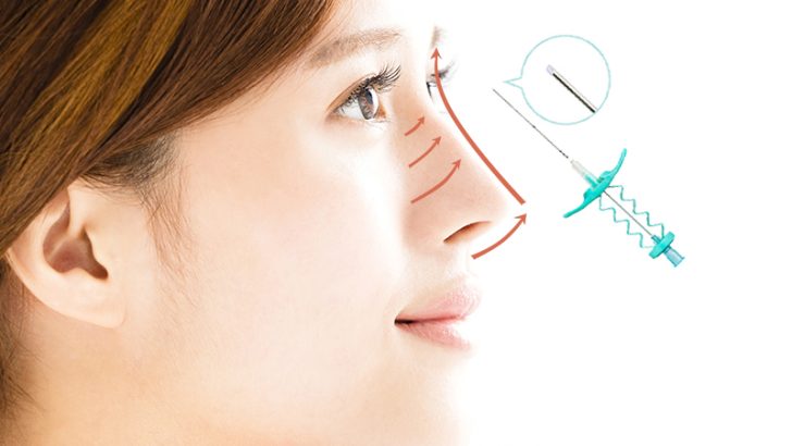 Nâng mũi bằng chỉ là một phương pháp thẩm mỹ không phẫu thuật, có nhiều ưu điểm như không cần phẫu thuật