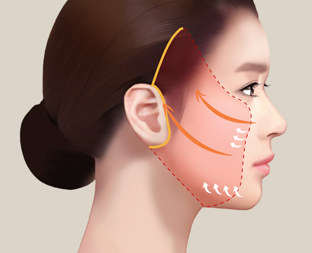 Căng da mặt là một dạng tiêu phẫu, nhằm kéo căng và loại bỏ phần da thừa, chảy xệ trên khuôn mặt.