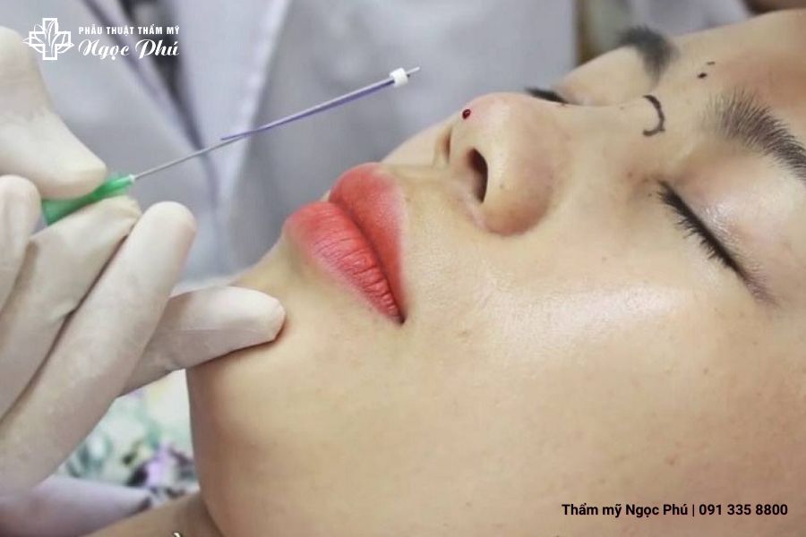 Nâng mũi bằng chỉ là phương pháp nhằm nâng cao sống mũi để giúp khách hàng đạt được độ cao như ý mà không cần phải trải qua phẫu thuật thẩm mỹ.