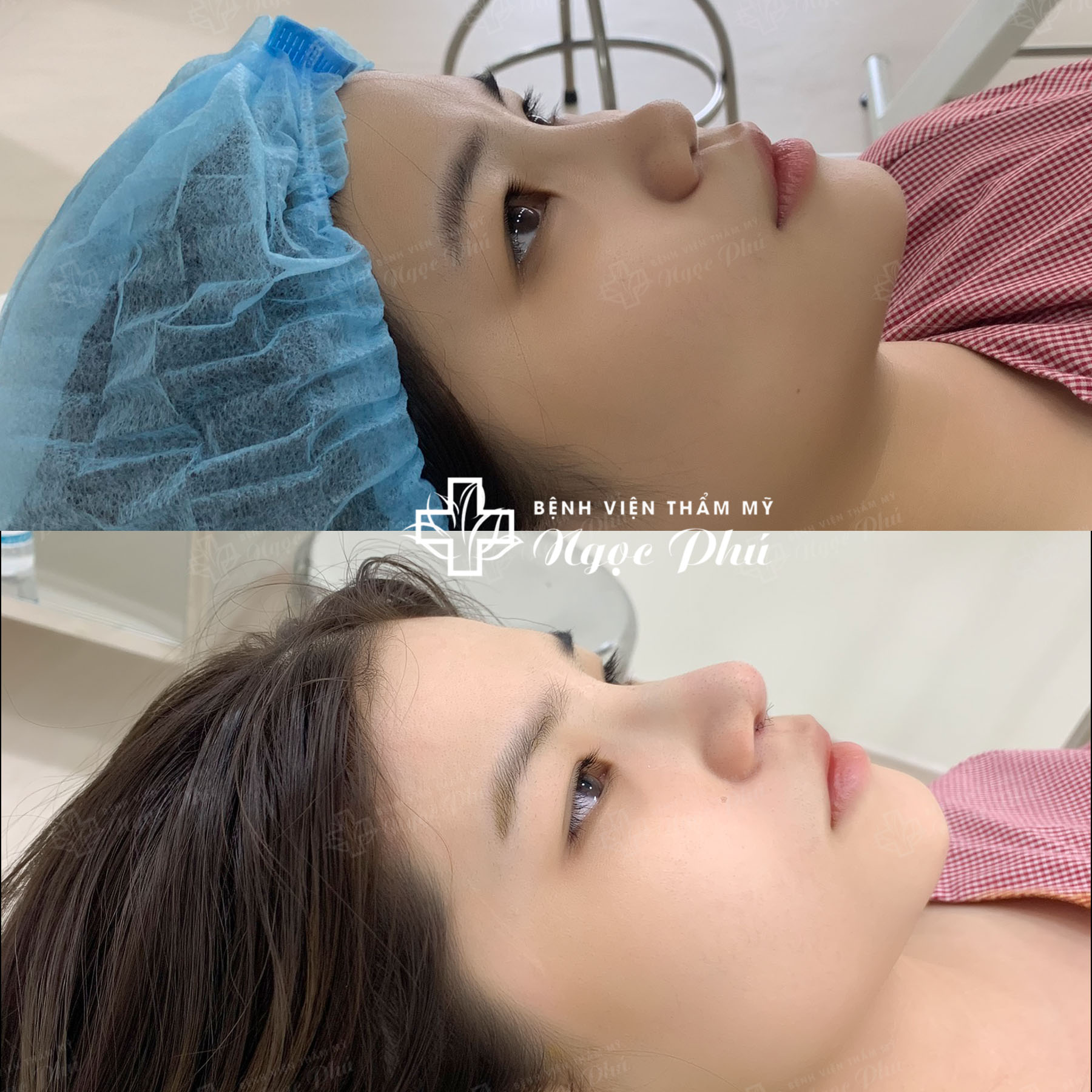 Phương pháp nâng mũi Hàn Quốc được thực hiện bằng cách sử dụng sụn nhân tạo cao cấp để nâng cao sống mũi, tạo hình đầu mũi, cánh mũi theo tỷ lệ vàng của khuôn mặt.