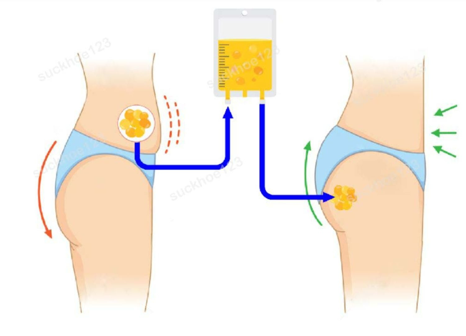 Hút mỡ bụng cấy vào mông được xem là một phương pháp tương đối an toàn so với các phương pháp phẫu thuật thẩm mỹ khác.