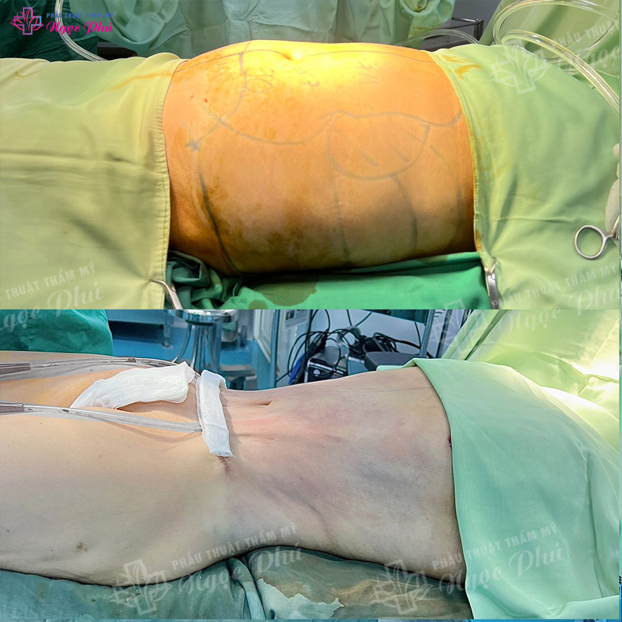 Hình ảnh trước và sau hút mỡ bụng của khách hàng tại Thẩm mỹ Ngọc Phú