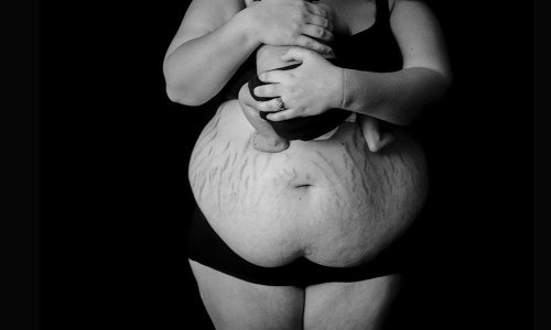 Sau khi sinh em bé, đa số chị em thường tăng cân nhiều, đặc biệt là sự chảy xệ và chùng nhão tại vòng 2.