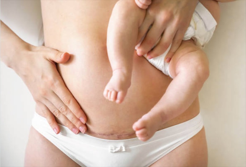 Đúng vậy, việc tích tụ mỡ thừa, đặc biệt là ở vùng bụng, sau khi sinh là điều vô cùng phổ biến.