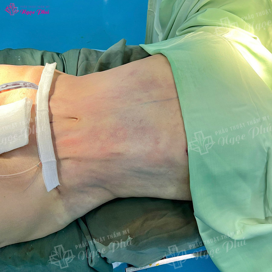 Quy trình hút mỡ căng da bụng tại Thẩm mỹ Ngọc Phú chuẩn y khoa