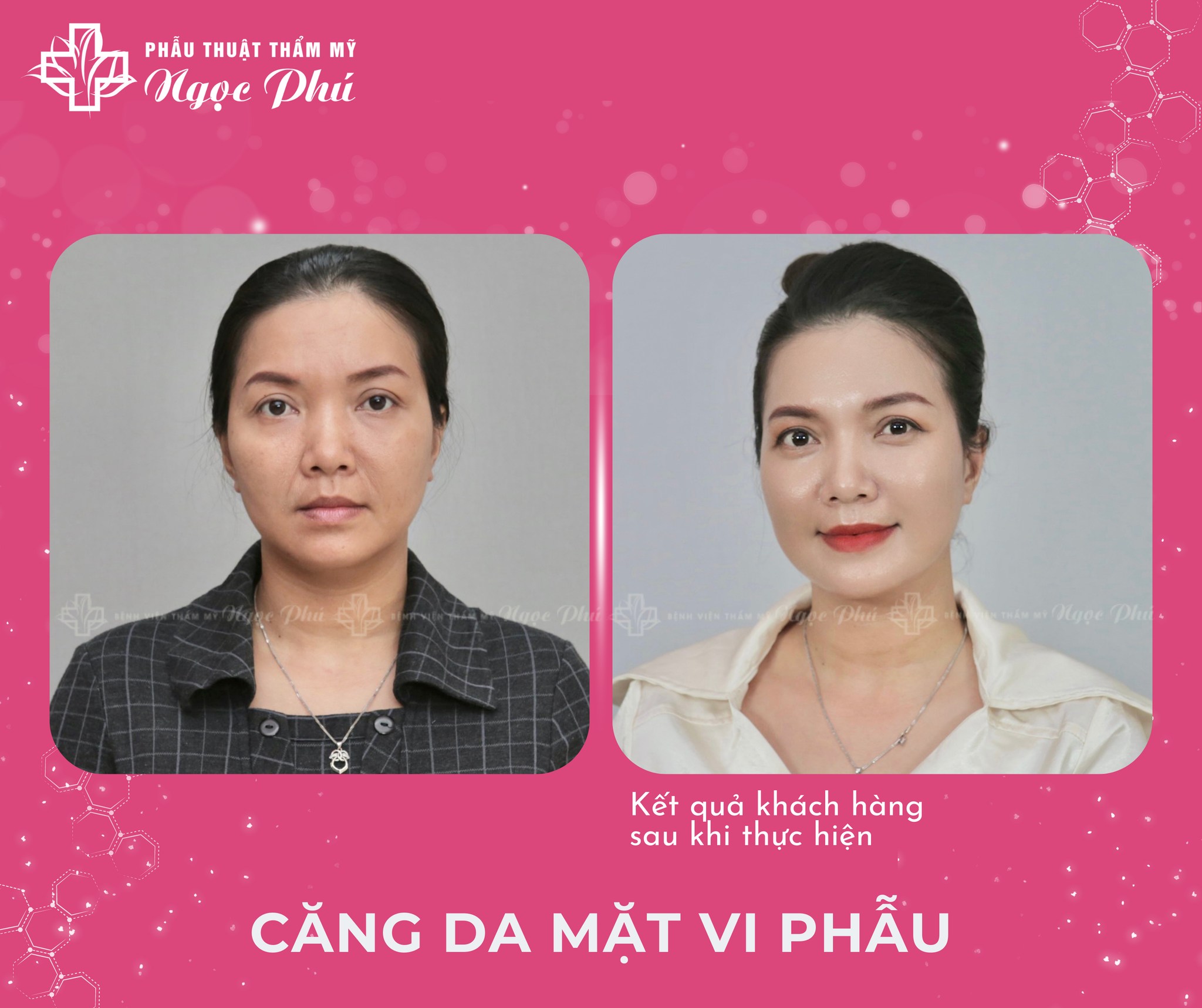 Hình ảnh khách hàng căng da mặt tại Thẩm mỹ Ngọc Phú