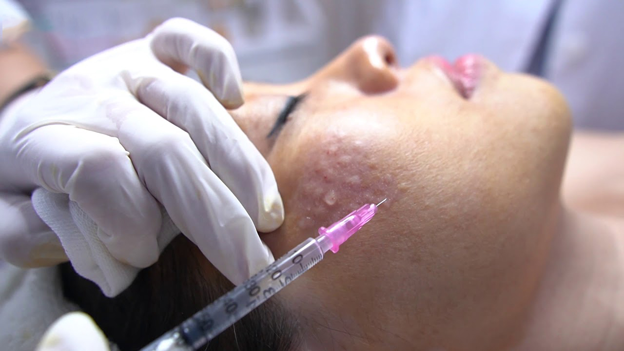 Tiêm Meso nám là phương pháp đưa trực tiếp các hoạt chất điều trị nám vào sâu vùng da cần điều trị. 