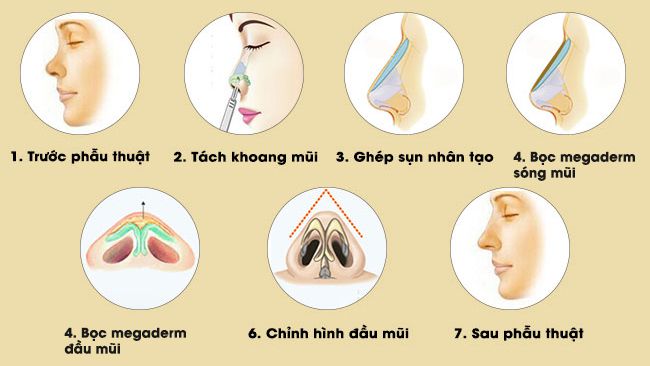 Hiện nay, nâng mũi là một phương pháp thu hút sự quan tâm rất nhiều phái nam và nữ, vì tính chất cải thiện khuyết điểm và làm đẹp mọi góc nhìn.
