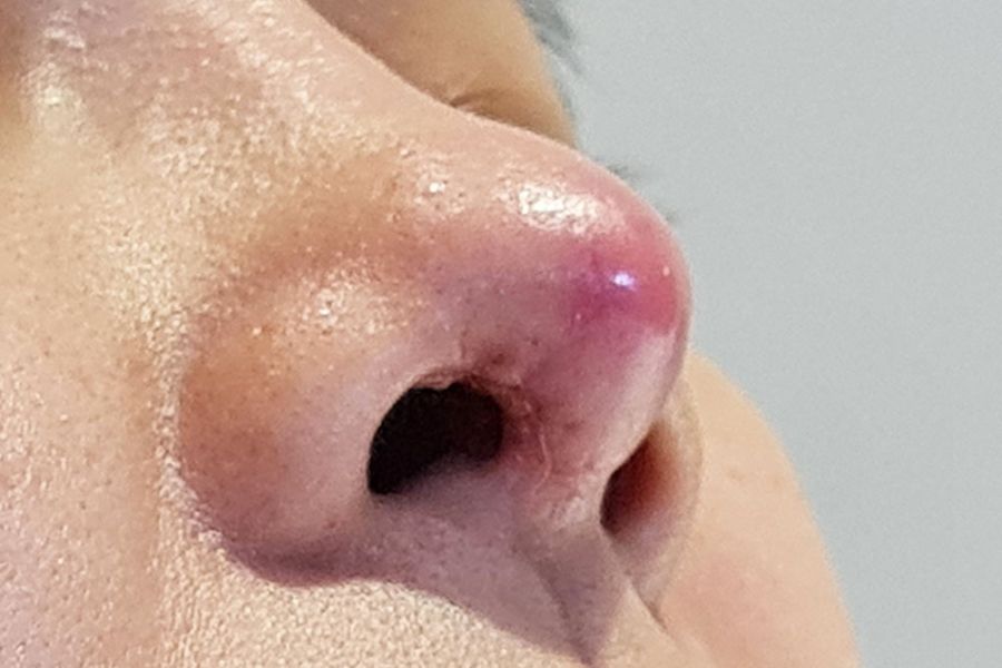 Hình 1: Nâng mũi sau 1 tháng vẫn bị đỏ và sưng viêm vùng mũi