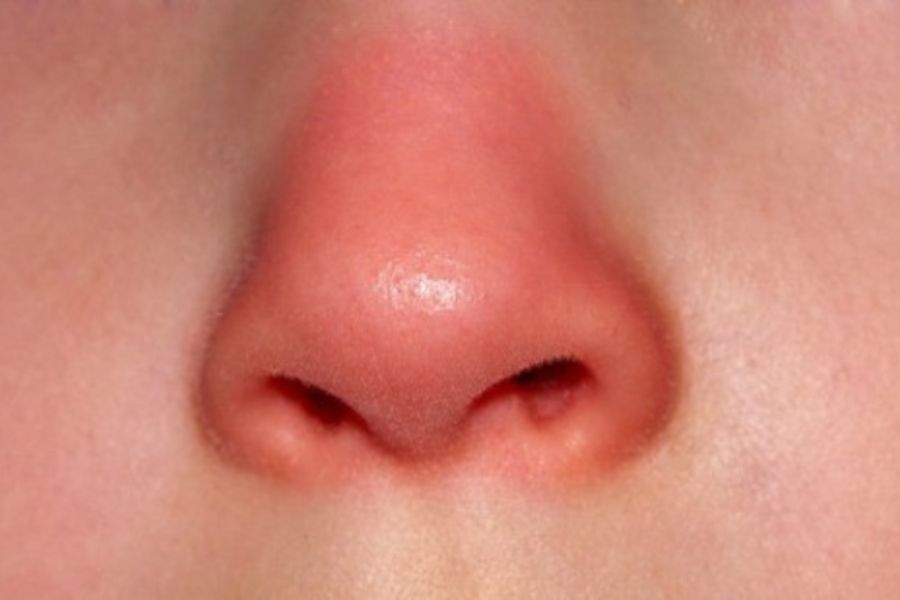 Sau khi nâng mũi hiện tượng sưng tấy vùng mũi là một hiện tượng vô cùng bình thường.
