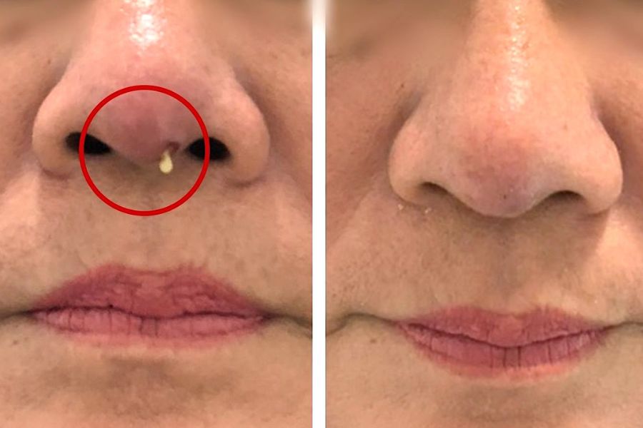 Một nguyên nhân có thể sẽ dẫn đến việc nâng mũi sau 3 tháng vẫn còn sưng tấy là do mũi bị nhiễm trùng. 