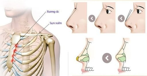 Nâng mũi sụn sườn sử dụng sụn tự thân từ vùng xương sườn của khách hàng.